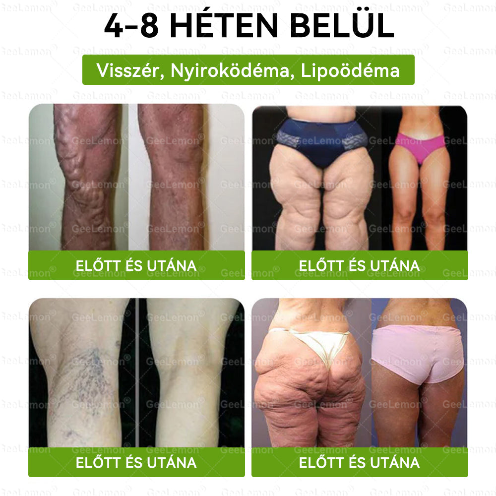🌿Hivatalos bolt | 𝐆𝐞𝑒𝐿𝑒𝐦𝐨𝐧® Glumasetide 8 az 1-ben Karcsú és Egészséges Nano Mikrotűs Tapasz (Napi 1×, látható változás 7 nap alatt) Berberin + Moringa ✅ Elhízásra, laza bőrre, cukorbetegségre, alvási apnoéra, ízületekre stb. 💥💥🇭🇺